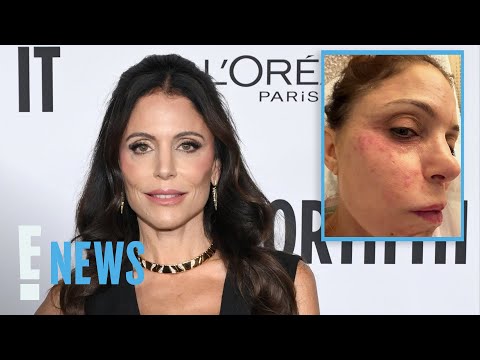Bethenny Frankel Contracts Bacterial Infection on Face in St. Barths | E! News